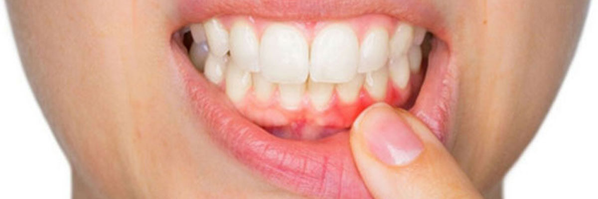 periodontitis