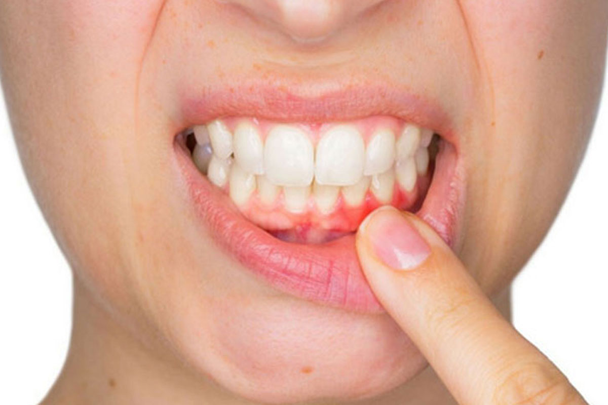 Secretos de una Boca Sana: Desenredando la Periodontitis