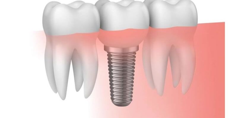 Implantología Dental Moderna