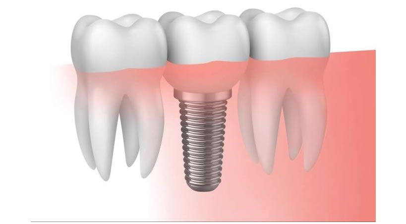 Avances en la Implantología Dental Moderna