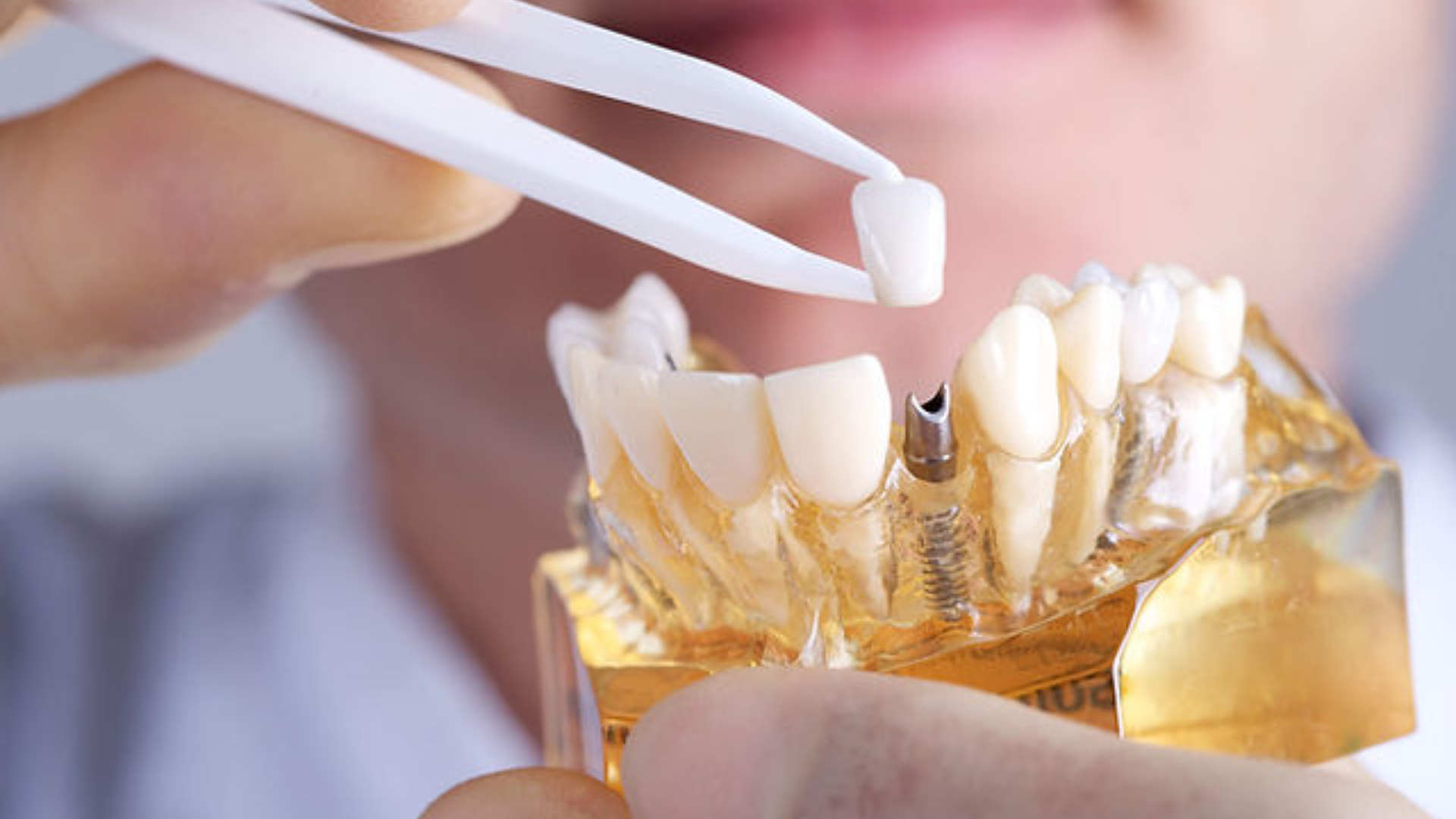 Implantes Dentales Gratuitos: ¡Guía para Obtenerlos!